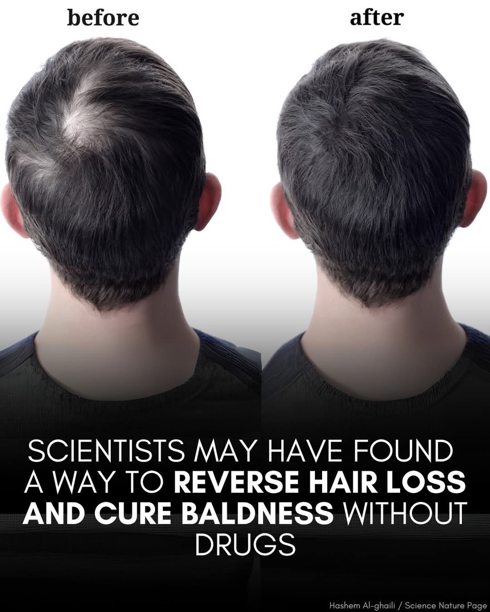JaysonDC123's tweet image. Scientists may have just found a drug-free cure for baldness.

A surprising discovery may offer hope to millions struggling with hair loss—and it doesn’t come in the form of a pill or cream. 

In a study published in Frontiers in Pharmacology, researchers found that deoxyribose,…