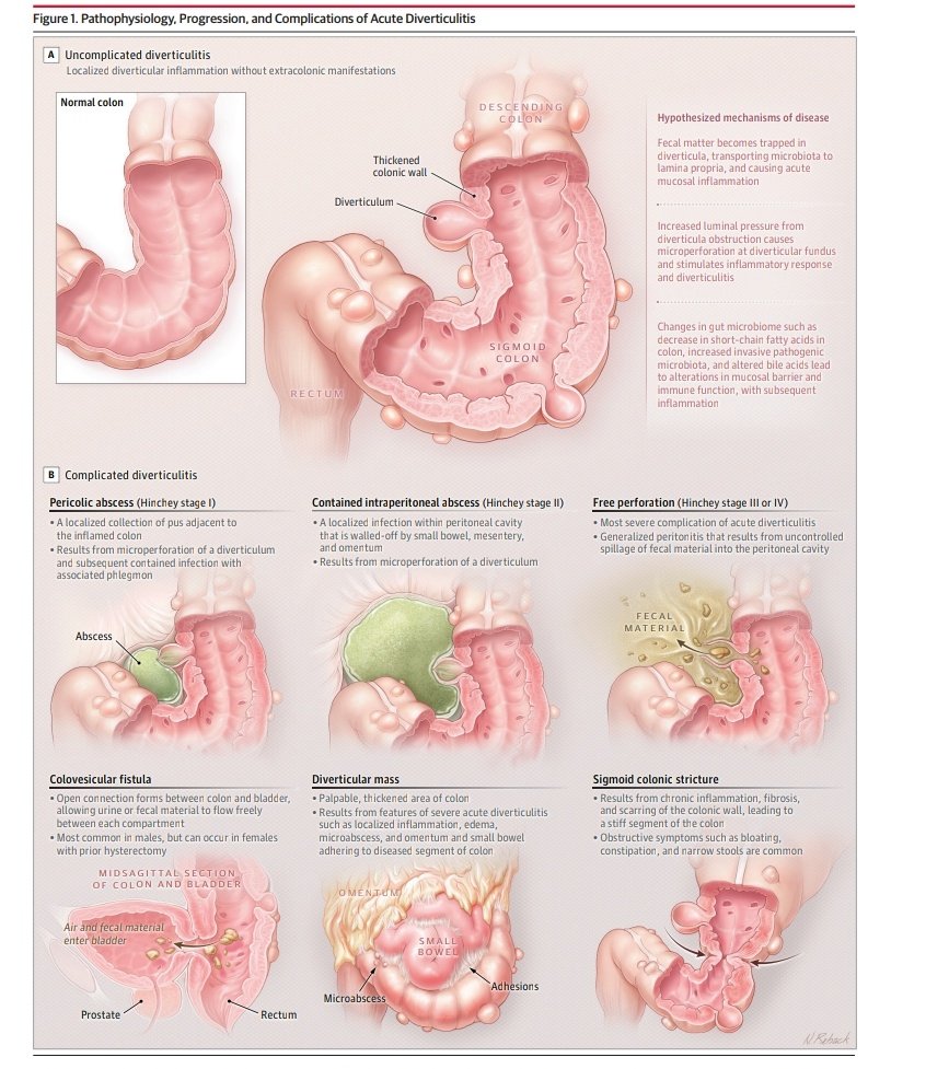 Diverticulitis 💥👌🏼

🔰📚JAMA 2025

doi:10.1001/jama.2025.10234

Enlace a Artículo Completo 👇🏼✅🆓t.me/SoMELaguna