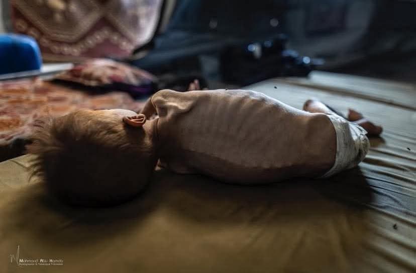 Marwa__Osman's tweet image. The third Palestinian child to die within 24 hours in Gaza;
Abdel Qader Al-Fayyoumi has succumbed to hunger and severe malnutrition in Gaza, a direct result of the ongoing siege, relentless genocide, and the Zionist occupation’s continued blockade of humanitarian aid.