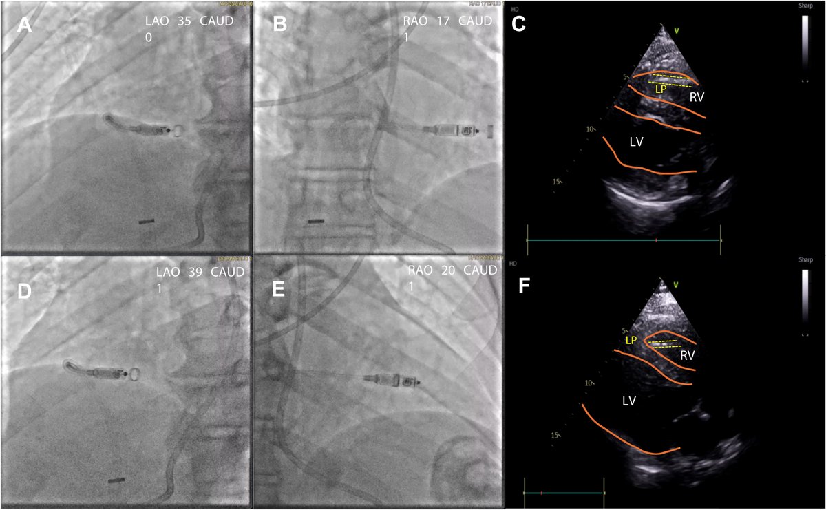 hrs_journal's tweet image. Step-by-step approach to ultrasound-guided leadless pacemaker implantation
@drjalajgarg #OpenAccess
heartrhythmjournal.com/article/S1547-…