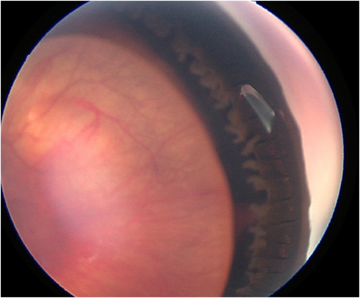 AAOjournal's tweet image. Sulcus Tube in a Patient with Axenfeld-Rieger Syndrome
ow.ly/fmzn50WcVLO
#ophthalmology #glaucoma