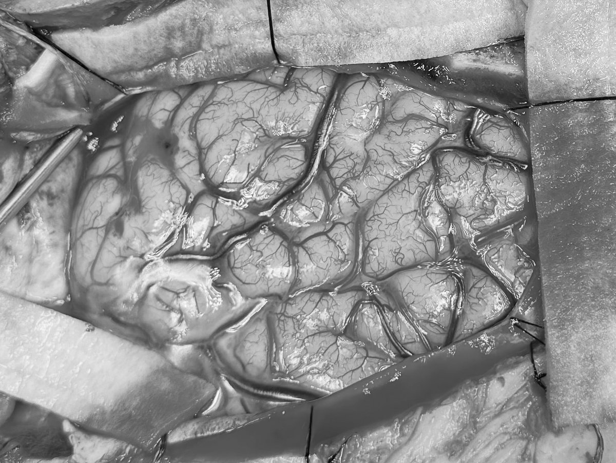 jshauptman's tweet image. Post-LITT ATLs seem to be more commonplace as LITT failure is probably in the 50-60% range for MTS. I think it’s even higher in children given MTS rarely isolated etiology. At our institution I talk a lot about proper informed consent for temporal LITT. I firmly believe the…