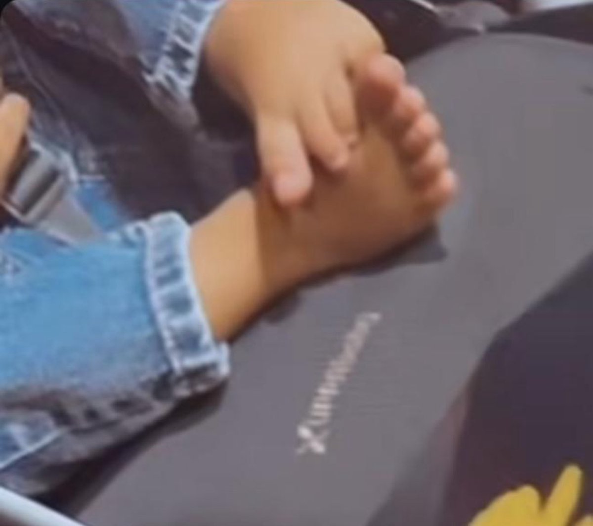 chriseanupdates's tweet image. At age 2, untreated or improperly treated clubfoot can:
•Cause difficulty walking
•Lead to pain or limping
•Affect the child’s leg muscle development
•Result in permanent disability if not corrected