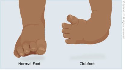chriseanupdates's tweet image. At age 2, untreated or improperly treated clubfoot can:
•Cause difficulty walking
•Lead to pain or limping
•Affect the child’s leg muscle development
•Result in permanent disability if not corrected