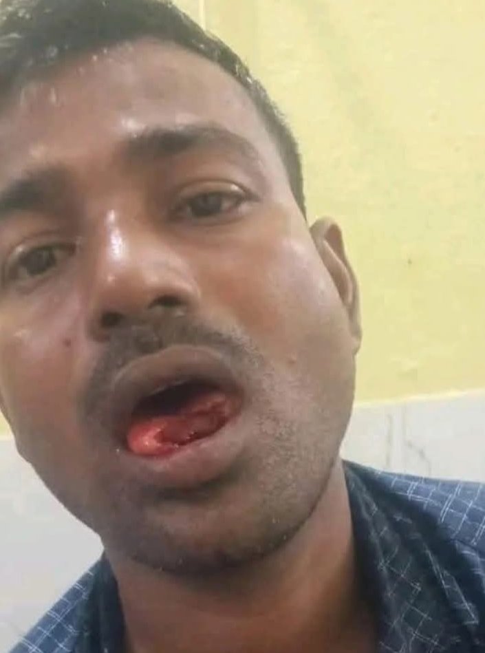 FMansikta60974's tweet image. बिहार --गया जी ।  पति की जीभ चबा गई पत्नी 
विवाद के बाद पति की जीभ की  दांतों से कटी डाली 😮‍💨🙏🤕
__गया 
#behar
#गया
#FamilyAffair 
#familyconflict 
#बिहार_चुनाव