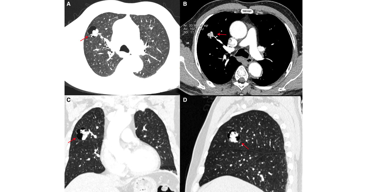 ATSBlueEditor's tweet image. Unusual Presentation of Clear Cell Tumor of the Lung as Irregular Nodules with a Thin-walled Cavity
@atscommunity 

🔗 tinyurl.com/yc7pxh2m