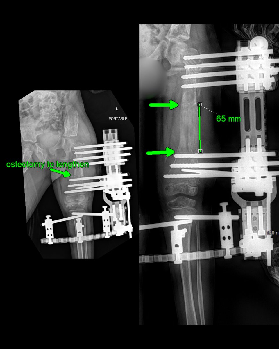 Londyn, 3, was born with Congenital Femoral Deficiency. After a SUPER Hip reconstruction at 18 months, she began limb lengthening this spring. Twelve weeks later, she’s grown 6.5 cm of new bone—one step closer to balanced mobility.