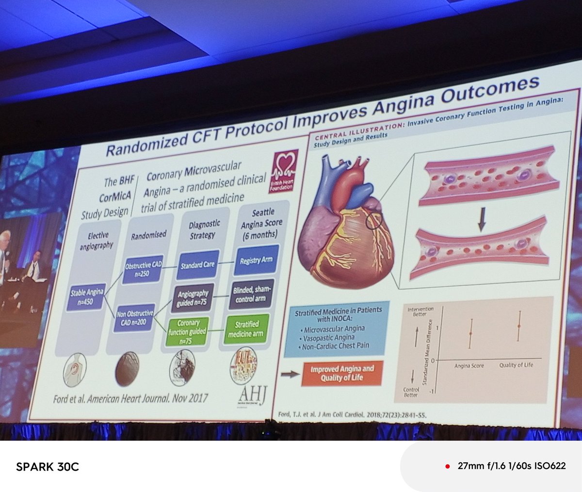 ZainabDakhil2's tweet image. Other amazing slides by @HenrytTimothy on #INOCA #CMD @cvinnovations #CVI2025 @arnoldseto @chadialraies @esbrilakis @shishem @psorajja @timir_paul @mirvatalasnag @Pooh_Velagapudi @mmamas1973 @DrMarthaGulati @InocaInternati1