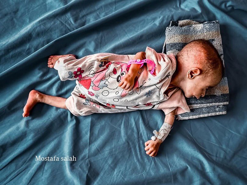 EyeonPalestine's tweet photo. Famine is devastating children, and the number of malnutrition cases is rising at an alarming rate amid a deafening global silence.
Among the cases:
Joudi Sharif Al-Arour
Age: 6 months - her frail body can no longer resist hunger.
For help and support: +970599770028 /+972
المجاعة تفتك بالأطفال، وأعداد المصابين بسوء التغذية ترتفع بشكل مرعب
وسط صمت عالمي مطبق.
من بين الحالات:
الطفلة جودي شريف العرور
العمر: 6 شهور - جسدها الهزيل لا يقوى على مق اومة الجوع