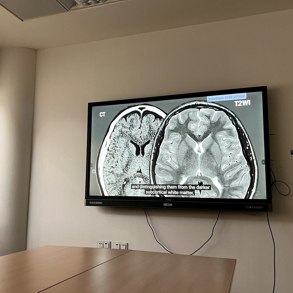 سارة آل الشيخ (@saraalsheikhh) on Twitter photo Just completed my Neurology Summer Elective at KKUH 🧠
Thanks to Dr. <a href="/Anas_AlRohimi/">Anas Alrohimi</a> & <a href="/drsaljarallah/">د . سلمان الجارالله</a> for pushing us to learn and engage, and to the residents who made time to teach and support us.
Leaving this elective with a deeper appreciation for this fascinating specialty! Just completed my Neurology Summer Elective at KKUH 🧠
Thanks to Dr. <a href="/Anas_AlRohimi/">Anas Alrohimi</a> & <a href="/drsaljarallah/">د . سلمان الجارالله</a> for pushing us to learn and engage, and to the residents who made time to teach and support us.
Leaving this elective with a deeper appreciation for this fascinating specialty!