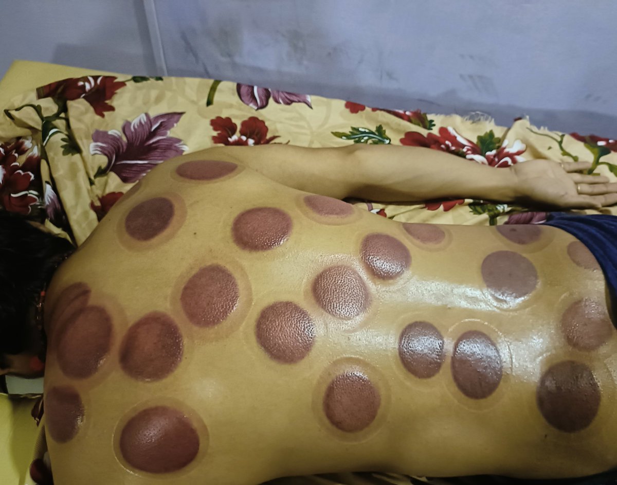 dryeye_dry2's tweet image. यस्तो थेरापी गरियो ।
हुन त जती जे गरेनी आज सम्म निको भएको त होइन । 😢