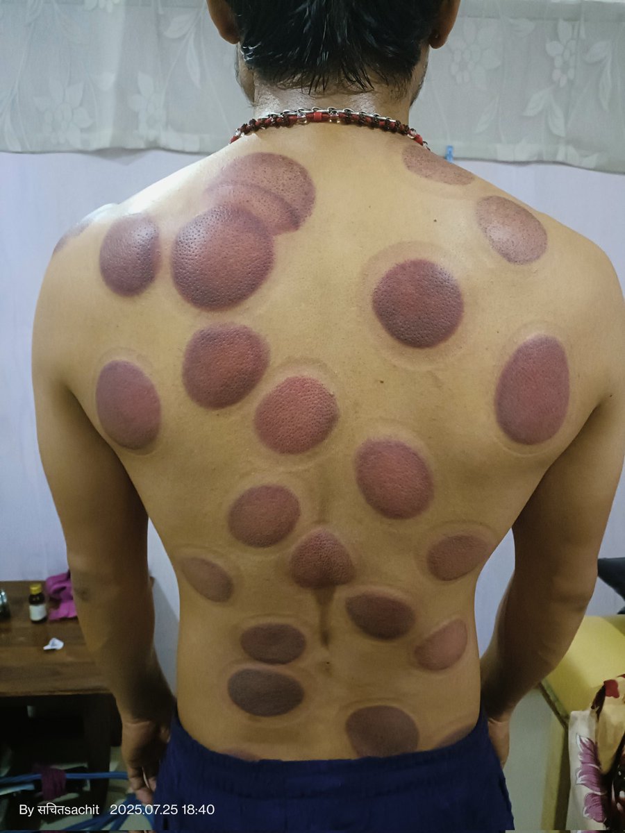 dryeye_dry2's tweet image. यस्तो थेरापी गरियो ।
हुन त जती जे गरेनी आज सम्म निको भएको त होइन । 😢