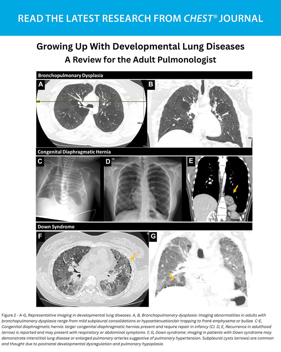 journal_CHEST's tweet image. A #CHESTReview aims to provide a framework for evaluating and managing individuals with developmental lung diseases.
Read more in the July issue of the journal CHEST®: hubs.la/Q03yRLPN0
#MedEd #JournalCHEST