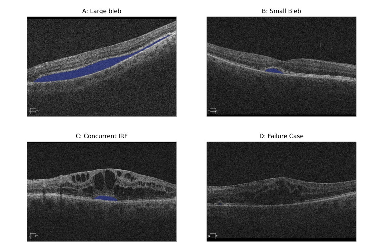AAOjournal's tweet image. Automated segmentation of subretinal fluid from optical coherence tomography: A vision transformer approach with cross-validation
ow.ly/5Alw50WikeQ
#ophthalmology