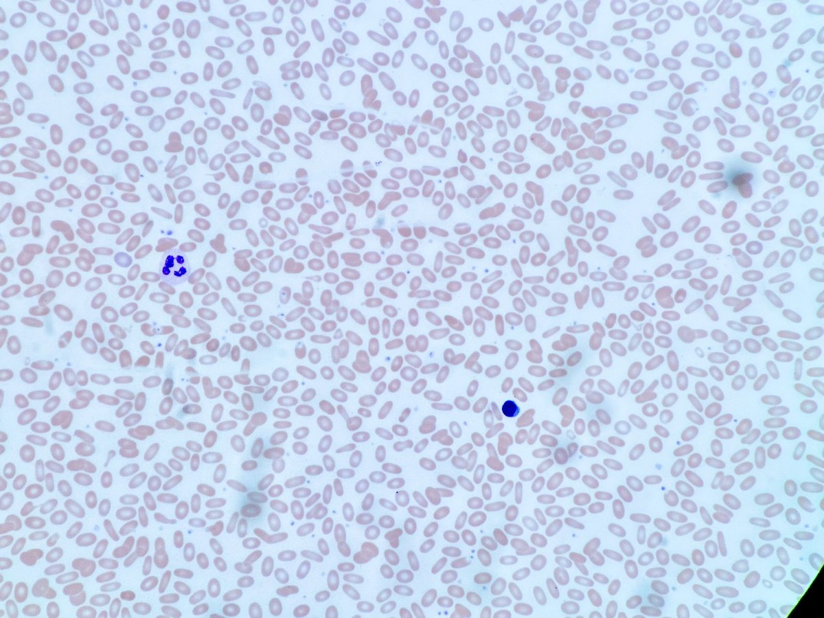 PathologyKate's tweet image. Name the diagnosis! And for extra points, what’s the name of the mutated protein??