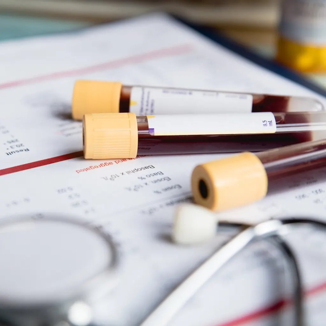 medcentralmd's tweet image. Ready to address rising patient interest in blood-based testing? The #Lumipulse pTau217/Aβ42 plasma ratio provides a scalable, minimally invasive method to detect #AmyloidPlaques—enabling earlier, more accessible #Alzheimers diagnoses. bit.ly/3H0NMoW #Biomarkers
