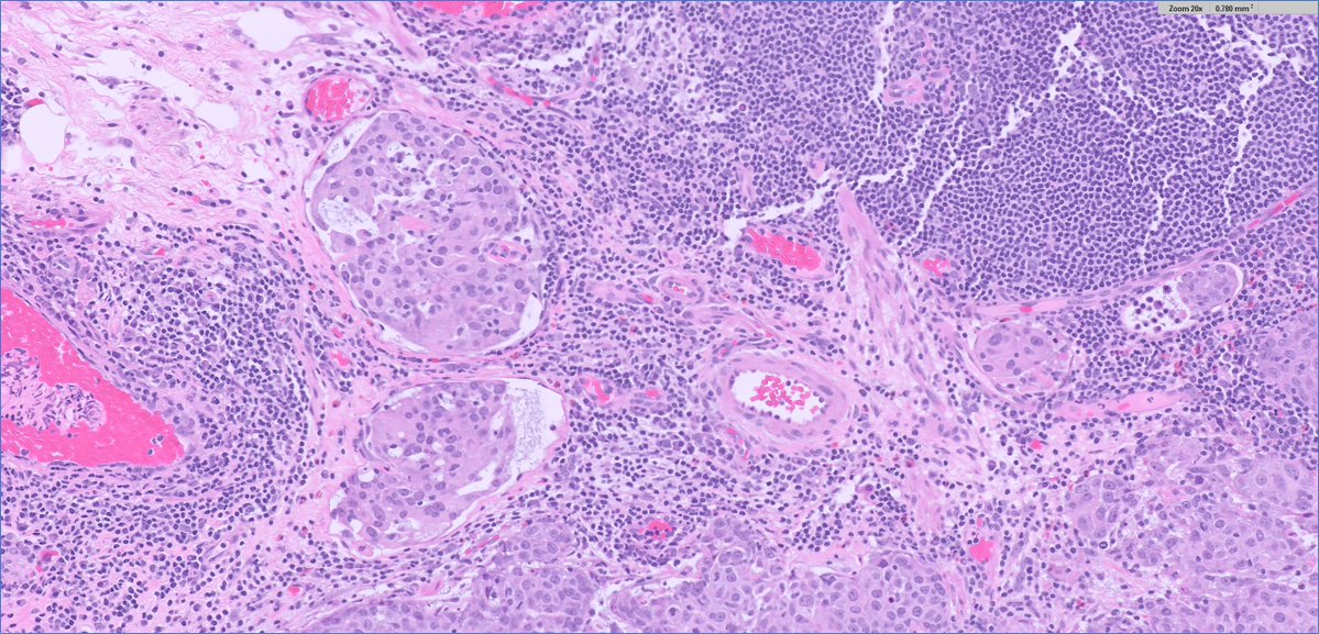 while you're better off using a "lymphatic specific" #IHCPath marker if you need to sort out lymphatic vs vascular invasion, often with CD31 the fainter staining pattern is seen in LYMPHATIC invasion

✔️here, #GUpath TURBT with LVI (likely "lymphatic" invasion)