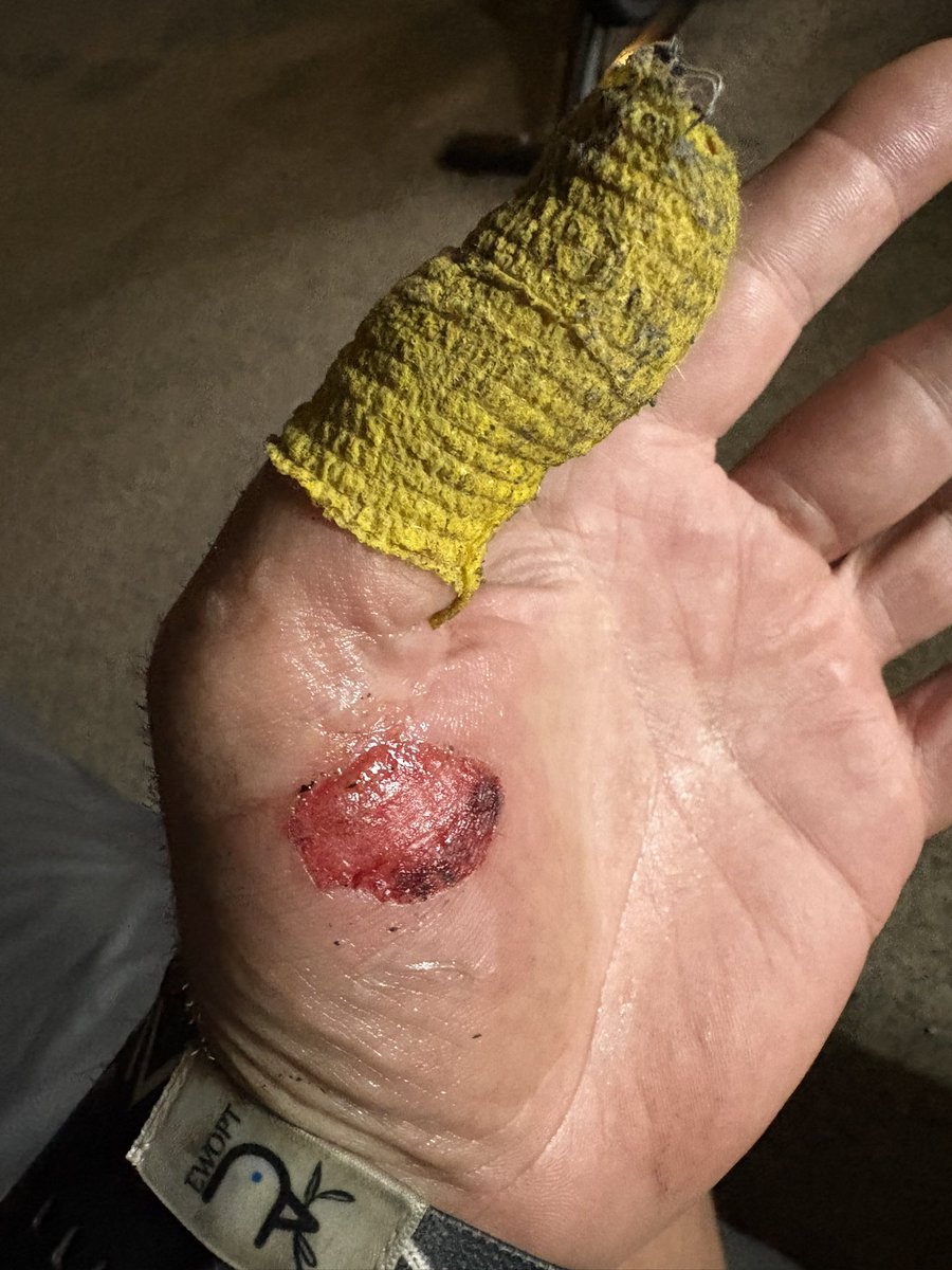 Well, photos are too graphic to post but here’s the clean version. Would appreciate the prayers during this time. 🙏🏻🙏🏻