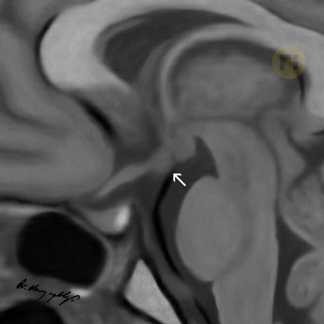 drharunyildiz's tweet image. X‐Linked Deafness DFNX2
(POU3F4 Mutation)
- Dysmorphic Hypothalamus
- Cochlear Incomplete Partition Type III
📌 Corkscrew Appearance
doi.org/10.3390/genes1…
#radiologicalillustration ✍️
pixel by pixel handmade!