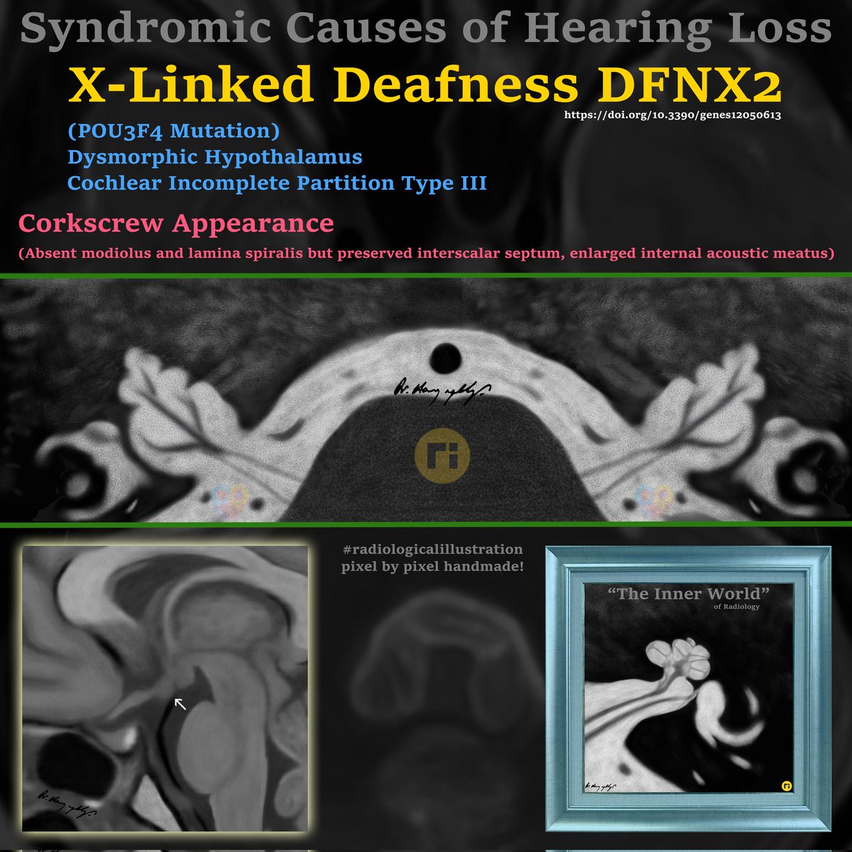 drharunyildiz's tweet image. X‐Linked Deafness DFNX2
(POU3F4 Mutation)
- Dysmorphic Hypothalamus
- Cochlear Incomplete Partition Type III
📌 Corkscrew Appearance
doi.org/10.3390/genes1…
#radiologicalillustration ✍️
pixel by pixel handmade!