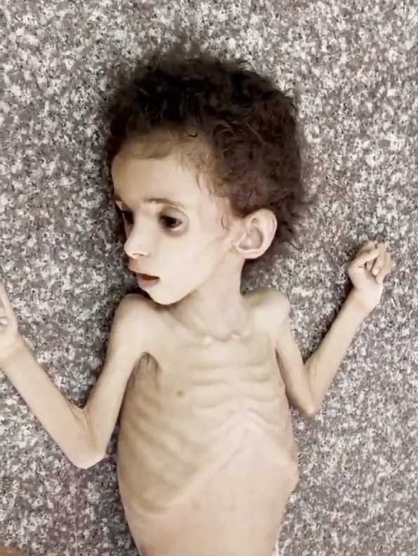 🕊️ Hommage à Razan : le devoir de ne jamais oublier

Le 12 juillet, nous alertions sur le sort de Razan, et des enfants affamés de Gaza.
Razan Abu Zaher avait 4 ans. Elle luttait encore.
Le 20 juillet, elle est morte.
Victime d’une famine méthodiquement organisée par le blocus