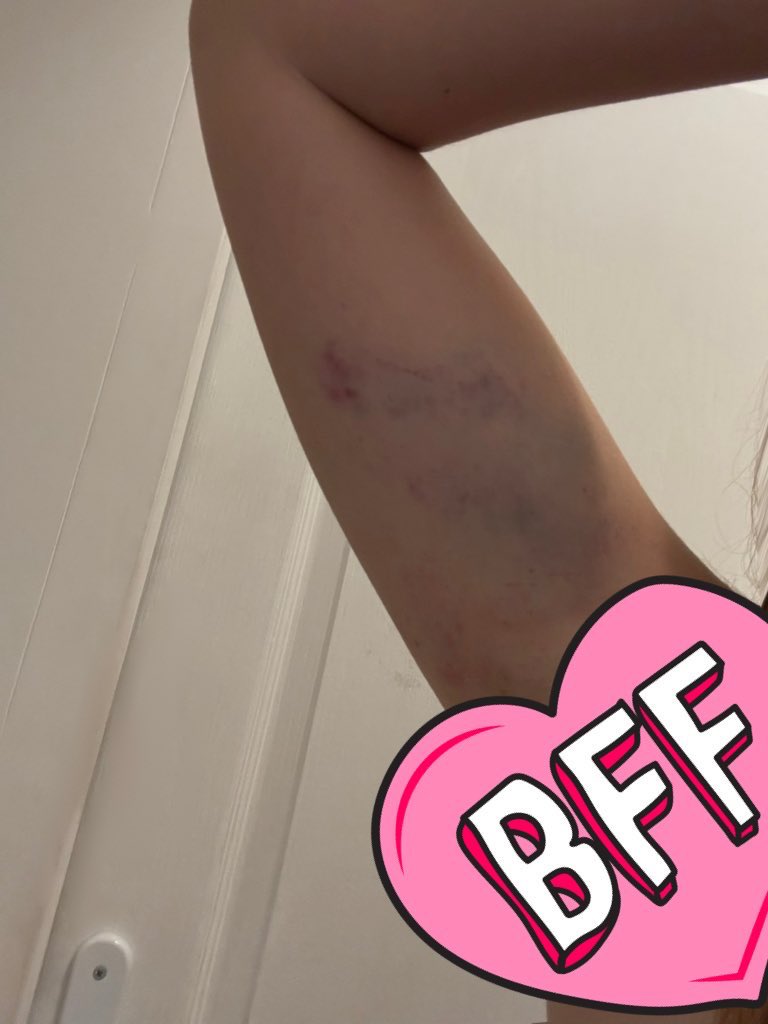maanlrt's tweet image. en tout cas 10/10 l’accrobranche piste noire que j’ai réussi à terminer au dépens de mes bras
