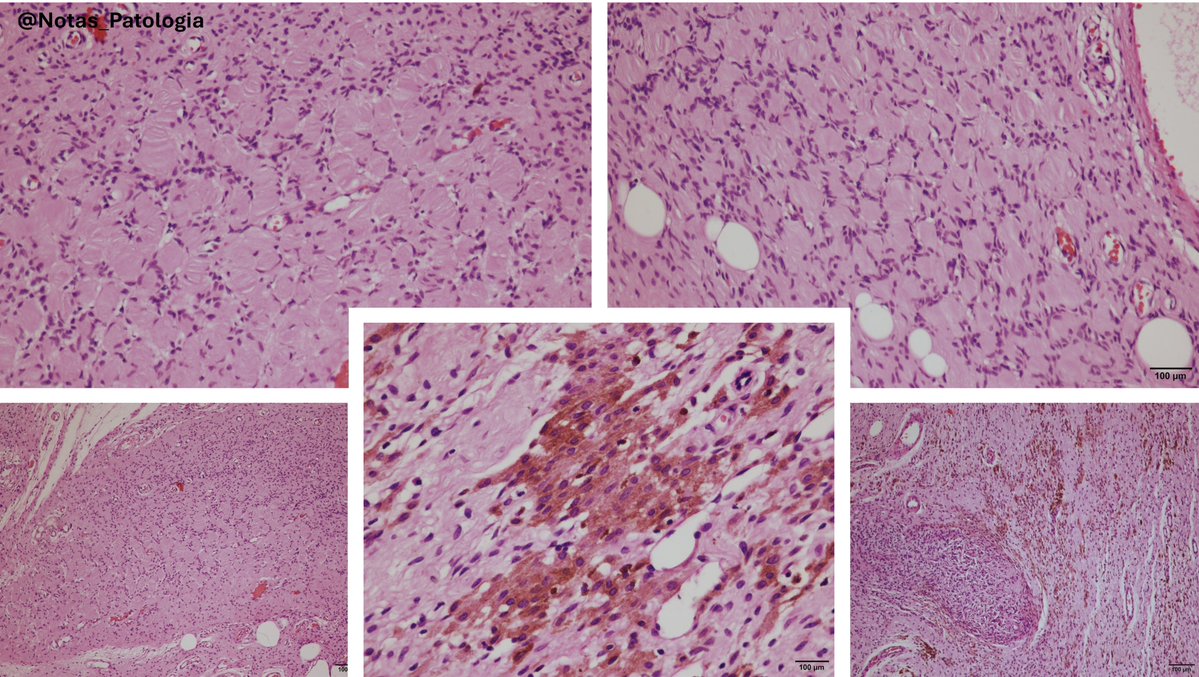 🔬 Pigmented Neurofibroma with Wagner–Meissner-like Bodies: a subtle but relevant histological clue

Pigmented diffuse neurofibroma is a rare variant of peripheral nerve sheath tumors, characterized by:

✔️ A diffuse proliferation pattern of Schwann cells
✔️ Presence of