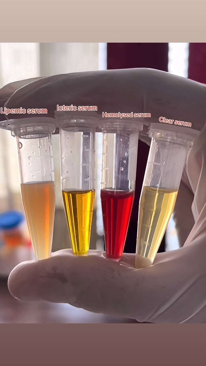 السيروم الطبيعي مقارنة بالغير طبيعي 👌🏻

#مختبرات_طبية