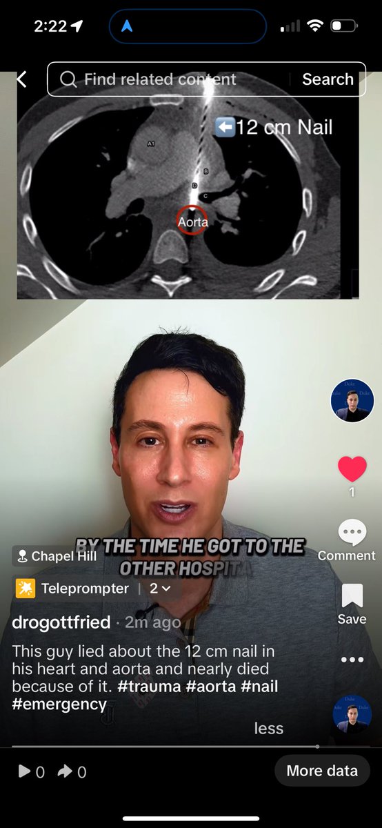 OGdukeneurosurg's tweet image. Man survives 12 cm nail into his heart and aorta, but nearly didn’t make it because of his deception