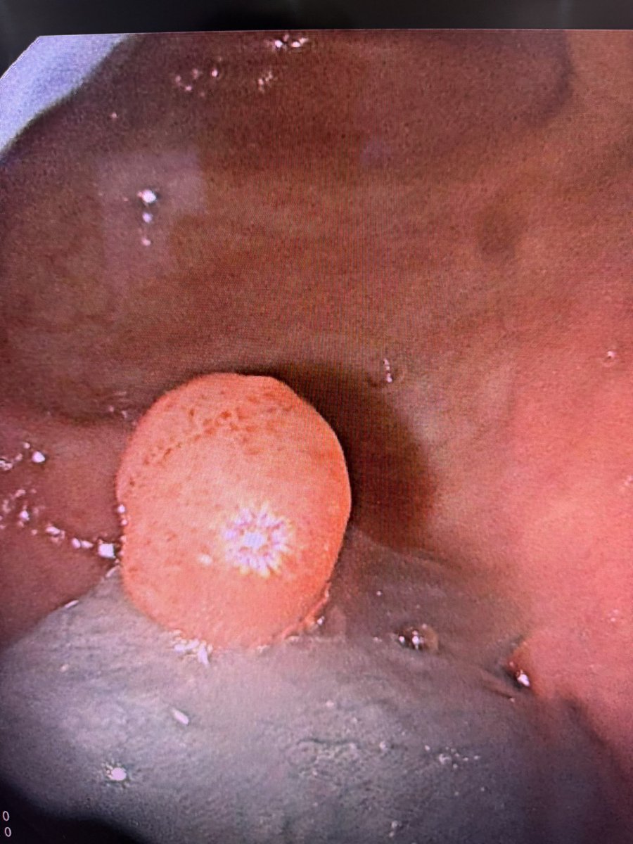 DoctorHumber's tweet image. Polipectomía con asa fría en paciente con pólipo en colon sigmoide 🙏