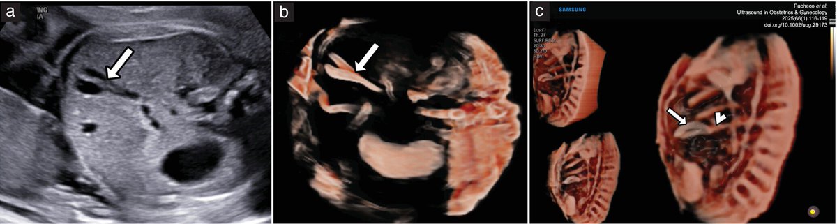 Pacheco et al. present a case of duplicated gallbladder with a common cystic duct, imaged using 3D ultrasound with Crystal Vue™ and Realistic Vue. Explore the full article, with details on the generation of a 3D printed model, in #UOGJournal. bit.ly/3TjTZQ0