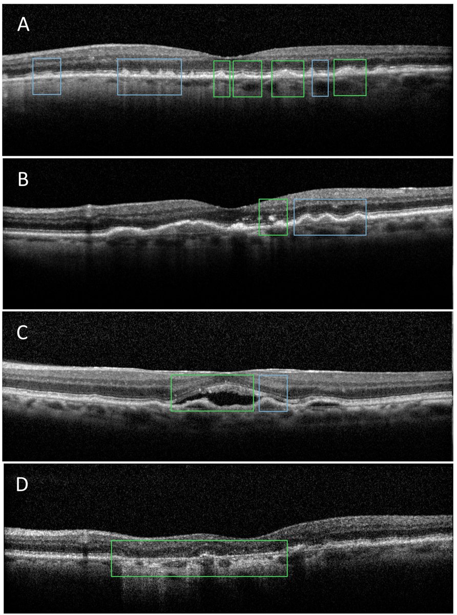 AAOjournal's tweet image. Genetic Risk and OCT-Based Phenotypic Associations in Age-Related Macular Degeneration
ow.ly/XAfn50WcVTU