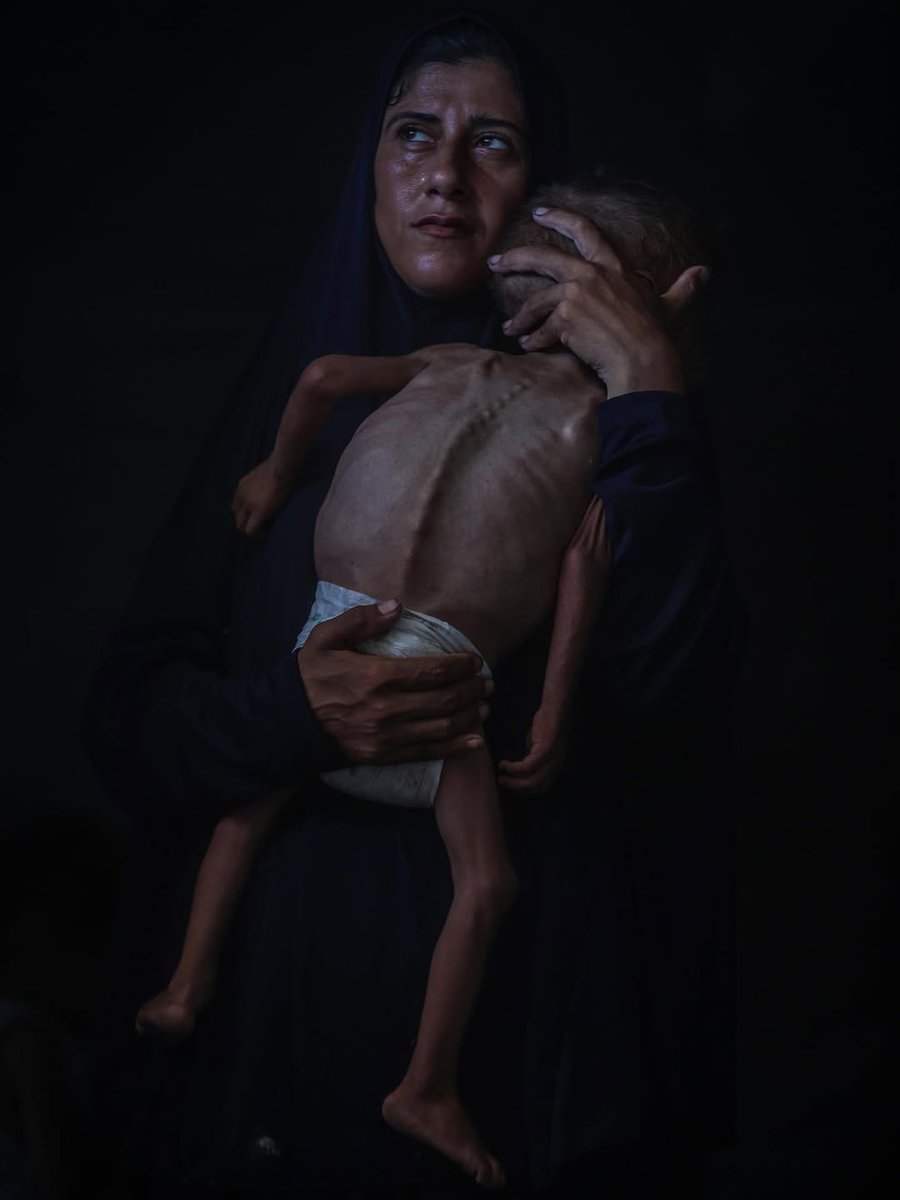 Timesofgaza's tweet photo. Mohammed Al-Matouq, a one-and-a-half-year-old child, is among the many in Gaza suffering from hunger and severe malnutrition. His life is at serious risk due to the Israeli blockade and the systematic starvation imposed on the population. https://t.co/tsdSV7aZ8i