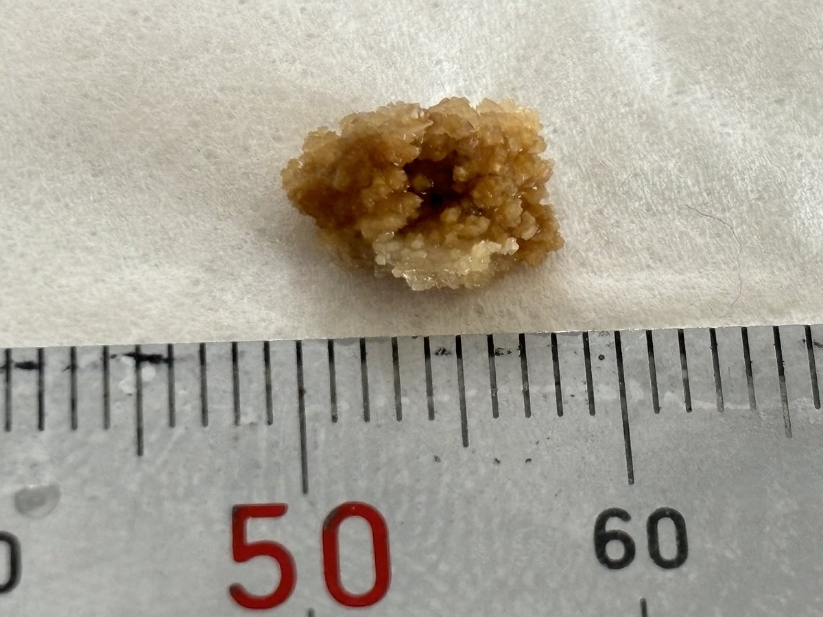 mode_jas's tweet image. ここ数年、濃い目のお茶を1リットル飲むのが日課になってたんですけど、調べたら緑茶は濃ければ濃いほどシュウ酸が多いんですってね‥‥
そのせいか、昨日は3mm玉が二つも出ましたよ(過去の最大記録は9mm‼️)💦
なので、、、、
今日からお茶やめて水飲みます💦💦
写真は以前出た9mm玉!