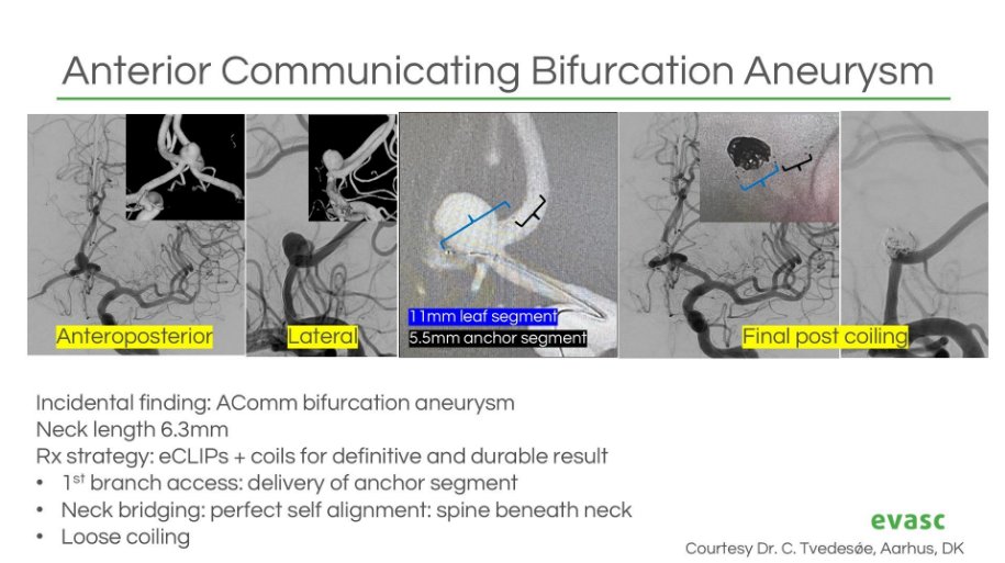 Congrats to Dr. Claus Tvedesøe on his 1st #eCLIPs case at Aarhus University Hospital!
Chosen over intrasacculars for an #AComm #aneurysm — thanks to eCLIPs' 96% likelihood of satisfactory occlusion at 3 years, with no safety events.
📊 Data coming soon
🔗 bit.ly/contact-evasc