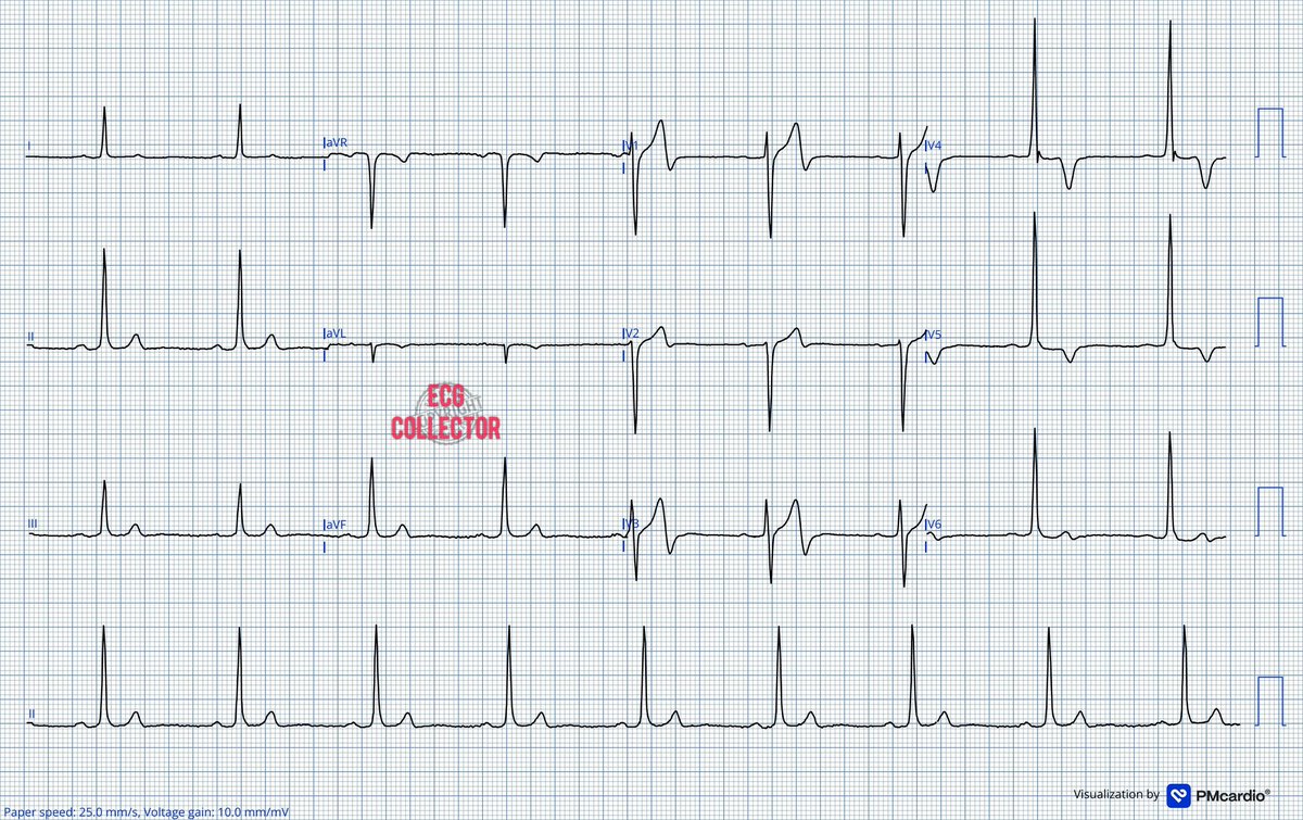 Dr Razi (@drrazi4) on Twitter photo #ecg belongs to 38 y.o male; active in sports; active smoker; came with history of chest pain past 2-3 days; on arrival PS 0/10; VS stable;
#ECG monitoring interval 30 minutes;
True OR fakeāš¤
#CardioTwitter
#Cardiology
#Medicalstudent
#MedTwitter
<a href="/PMcardioApp/">PMcardioāAI that reads ECGs</a> #ecg belongs to 38 y.o male; active in sports; active smoker; came with history of chest pain past 2-3 days; on arrival PS 0/10; VS stable;
#ECG monitoring interval 30 minutes;
True OR fakeāš¤
#CardioTwitter
#Cardiology
#Medicalstudent
#MedTwitter
<a href="/PMcardioApp/">PMcardioāAI that reads ECGs</a>