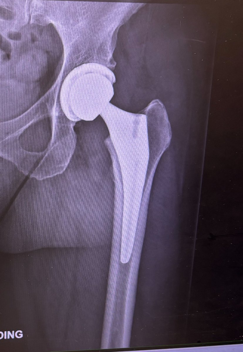 mkgoblue's tweet image. 6 weeks post op! Full mobility, zero pain. Hip replacement for me was the best surgery I could ever ask for. Pain before was so bad I couldn’t sleep or walk without pain pills - something I avoid at all costs. The day of my surgery I walked out of there and I never took more than…