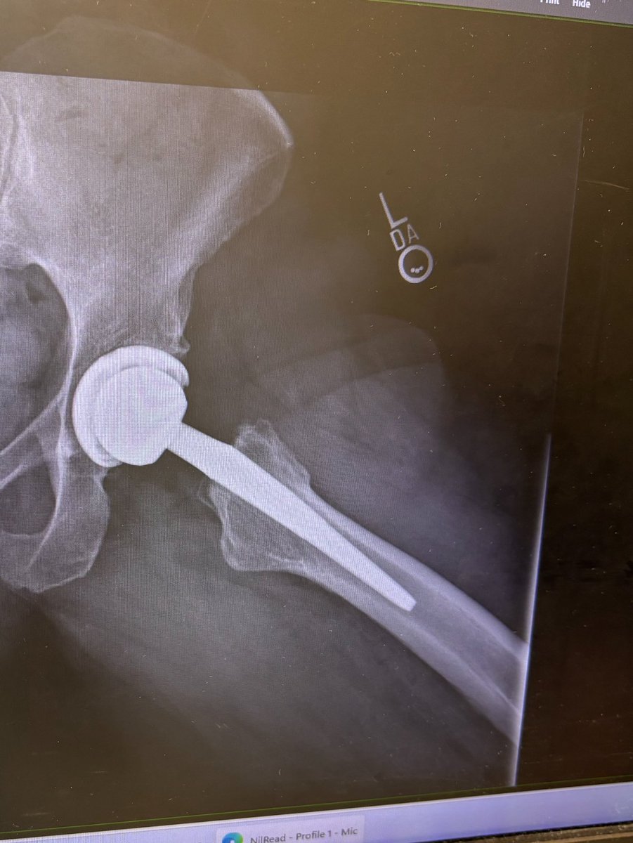 mkgoblue's tweet image. 6 weeks post op! Full mobility, zero pain. Hip replacement for me was the best surgery I could ever ask for. Pain before was so bad I couldn’t sleep or walk without pain pills - something I avoid at all costs. The day of my surgery I walked out of there and I never took more than…
