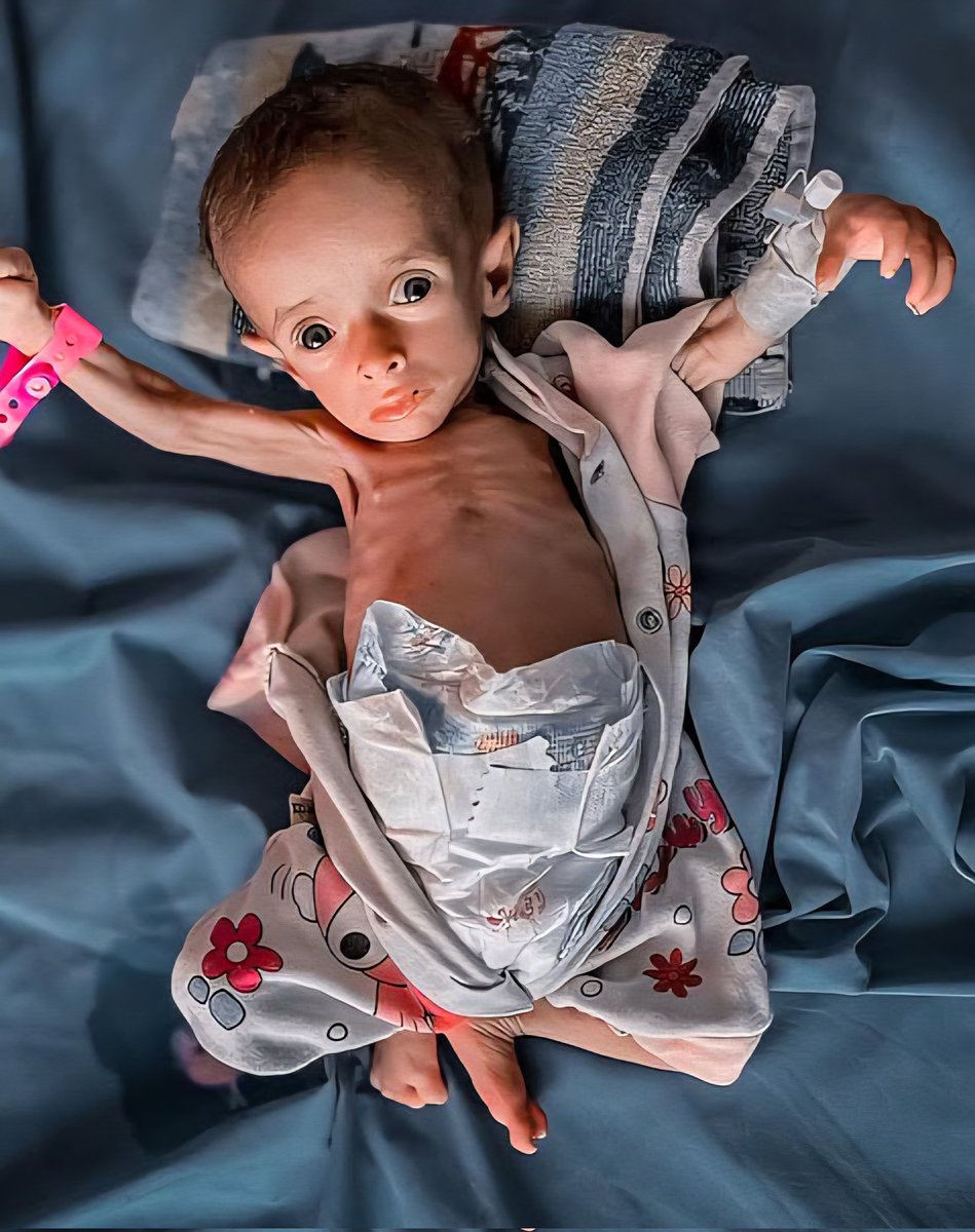 "طفلٌ في غزة... لم يبقَ من جسده سوى عظامٌ ناحلة، بعد أن التهمه الجوع شيئًا فشيئًا. نظراته لا تصرخ، بل تنزف ألماً. جسده الصغير يحتضر بصمتٍ موجع، بينما العالم يشيح بوجهه عن موتٍ بطيء يُفترش القلوب قبل الأرض."