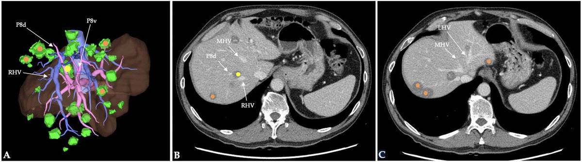 TorzilliGuido's tweet image. Pleased to announce the release of another scaffold sparing solution for boosting one stage removal of multiple bilobar colorectal liver metastases: SLICED LIVER HEPATECTOMY
@HumanitasMilano @HUNIMED
@IHPBA @AHPBA @EAHPBA @APHPBA @IASGO_1988 @SSATNews @SocSurgOnc @Aicep4
