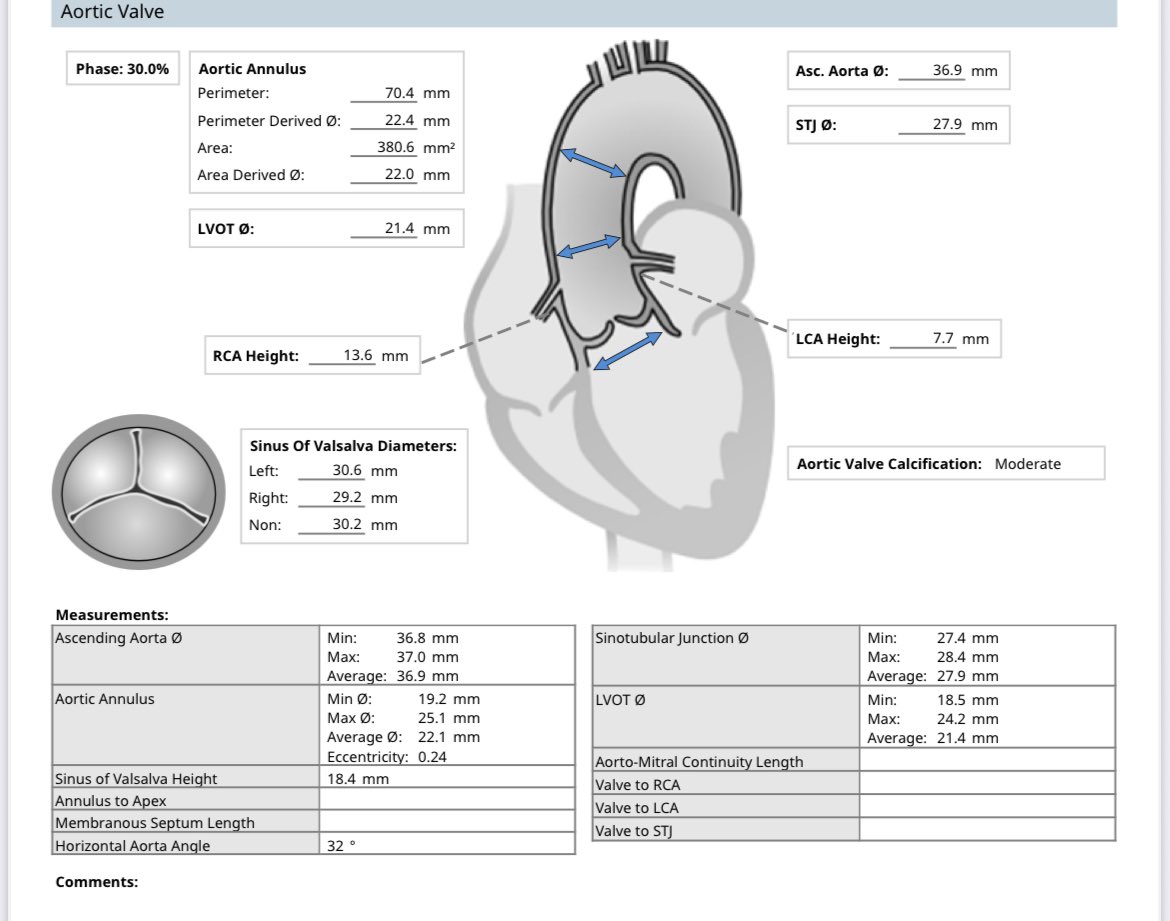 mirvatalasnag's tweet image. Morbidly obese (surgical turndown) with symptomatic severe AS
LCA height of 7.7 mm
What’s your plan for coronary protection?
@aelsab @CathElectroSurg @RodrigoBagur @LouaiRazzouk @MCoylewright @mathur_a @HindAlosaimi_ @TCT_ME_ @TAVRBot