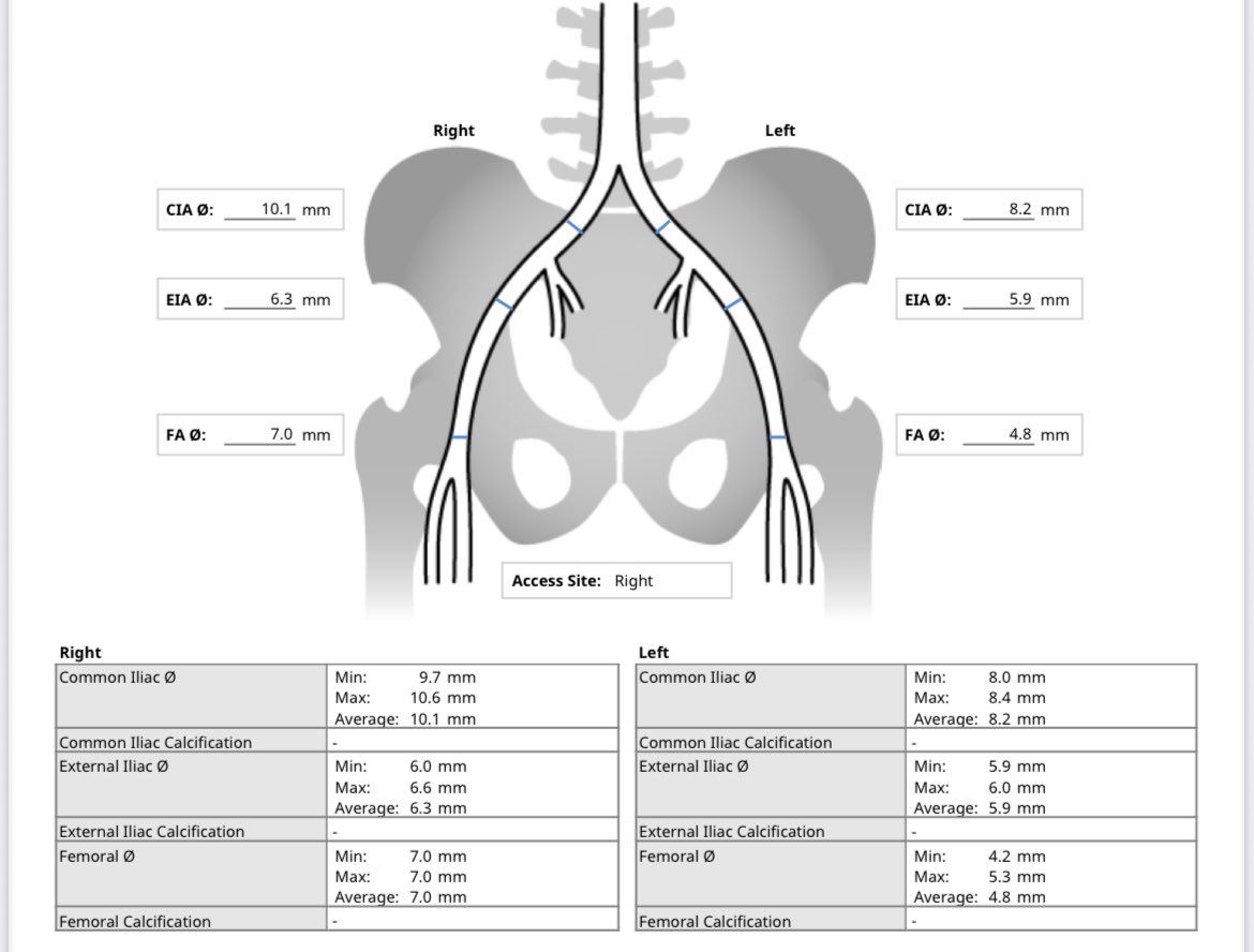 mirvatalasnag's tweet image. Morbidly obese (surgical turndown) with symptomatic severe AS
LCA height of 7.7 mm
What’s your plan for coronary protection?
@aelsab @CathElectroSurg @RodrigoBagur @LouaiRazzouk @MCoylewright @mathur_a @HindAlosaimi_ @TCT_ME_ @TAVRBot