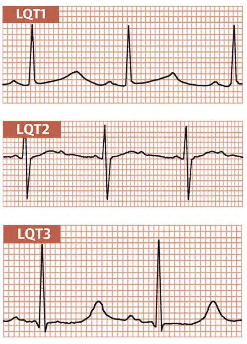 javier20ch's tweet image. Características EKG de los diferentes tipos de Síndrome QT Largo. 🫀⚡️
🔺️Sx QTL tipo1️⃣: Patrón de onda T de base amplia.
🔺️Sx QTL tipo2️⃣: con frecuencia tienen un patrón de onda T bífida de baja amplitud.
🔺️Sx QTL tipo3️⃣: con frecuencia tienen un patrón de onda T picuda o…