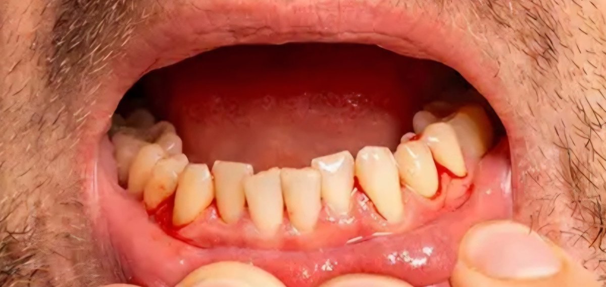 “Sema Mouth” &amp; “Sema Teeth”: Oral Health Impact of GLP-1 Agonists

🔍 Overview

GLP-1 receptor agonists (e.g., semaglutide/Ozempic, tirzepatide/Mounjaro) have transformed obesity and diabetes care. However, emerging reports highlight a spectrum of oral health complications