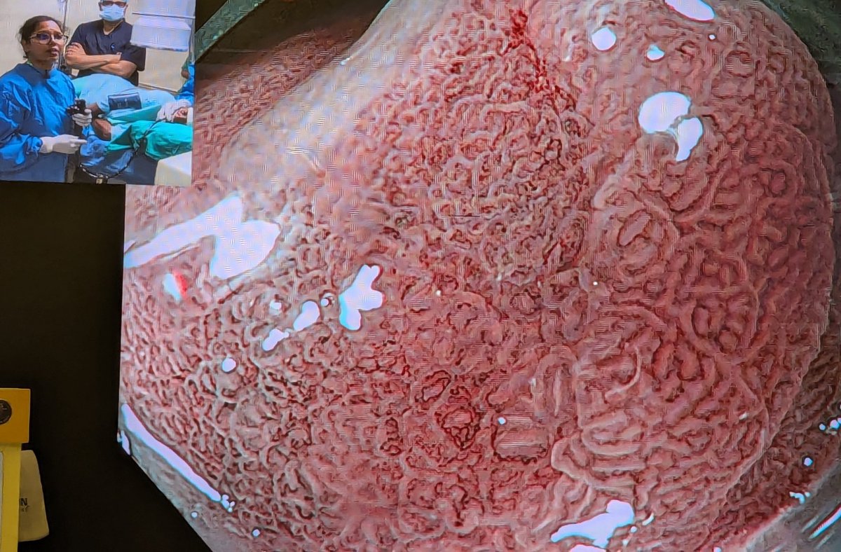 Srisha_Hebbar's tweet image. Truly amazing to see a small probable early gastric cancer picked up during a live case at Jaipur. This just emphasises the need for improving the quality of gastroscopy examination #Endocon2025 @UmairKamran11 @drkeithsiau @BritSocGastro