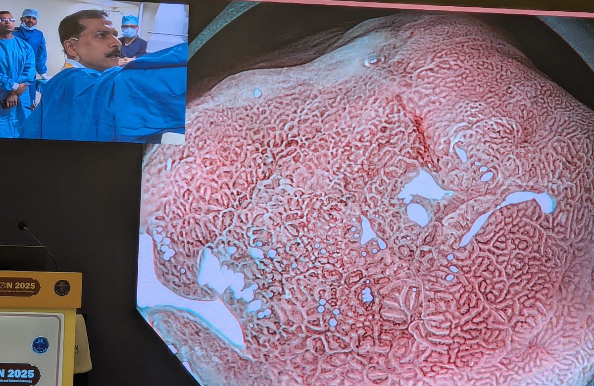 Srisha_Hebbar's tweet image. Truly amazing to see a small probable early gastric cancer picked up during a live case at Jaipur. This just emphasises the need for improving the quality of gastroscopy examination #Endocon2025 @UmairKamran11 @drkeithsiau @BritSocGastro