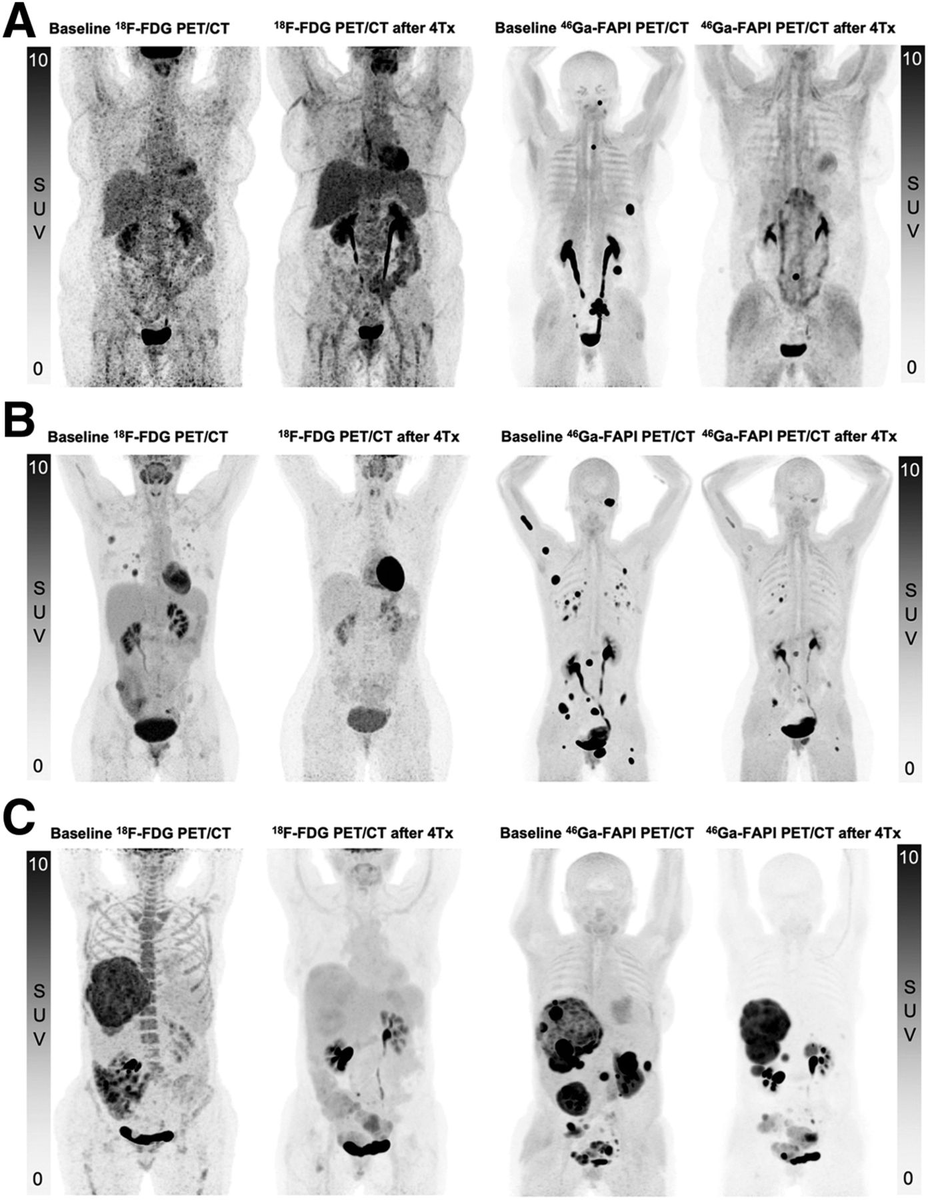 Finally, a killer application for Y-90 FAPI theranostics? 

Near complete metabolic responses in 3 patients with treatment refractory solitary fibrous tumors. Ga-68 FAPI had high SUVs (117, 41, 31) with concordant FDG uptake.

jnm.snmjournals.org/content/early/… <a href="/SNM_MI/">SNMMI</a> 

Wonderful work from