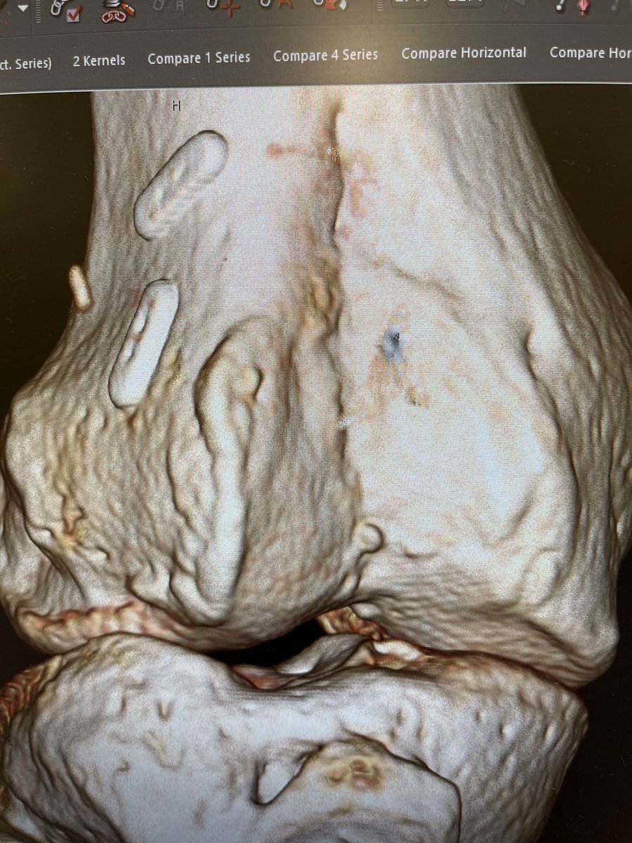 I’ve received images of seven failed trochleoplasties over the last few years, yet I haven’t seen an article on this topic. As I don’t do femoral trochleoplasties myself, other than proximal spur resections, I’d love to see images or comments on this topic. Attach in comments?