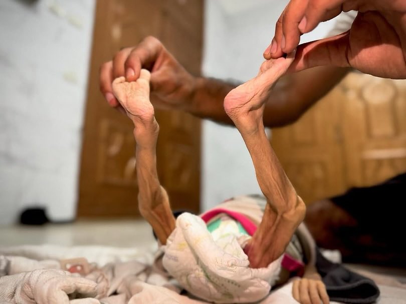 MoH:
Five people including three children died of hunger in the past 24 hours, raising the total to 127 including 85 children!