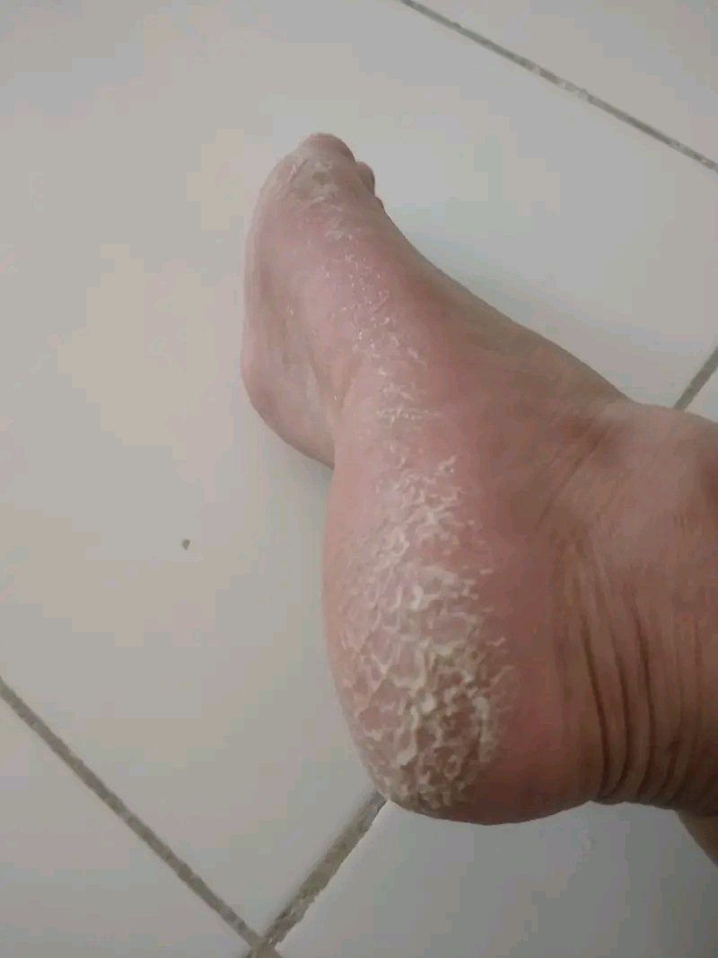 IamPrinceSanya2's tweet image. What should I buy to remove this from my wife's foot